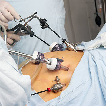 Laparoscopy