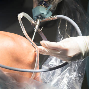 Arthroscopy